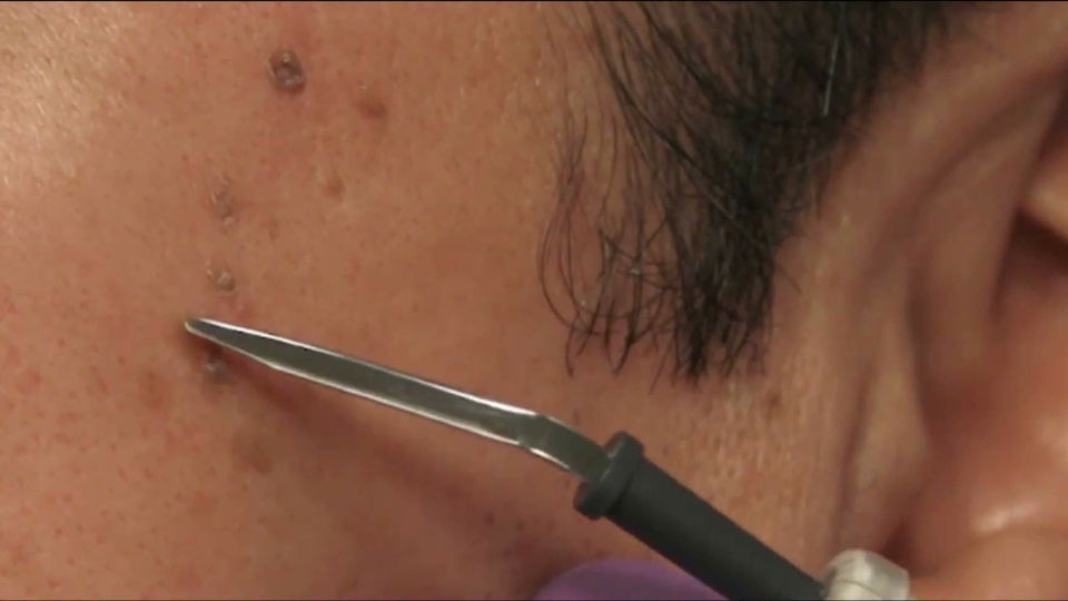 Aging spot removal